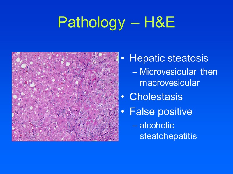 Pathology – H&E Hepatic steatosis Microvesicular then macrovesicular Cholestasis  False positive  alcoholic